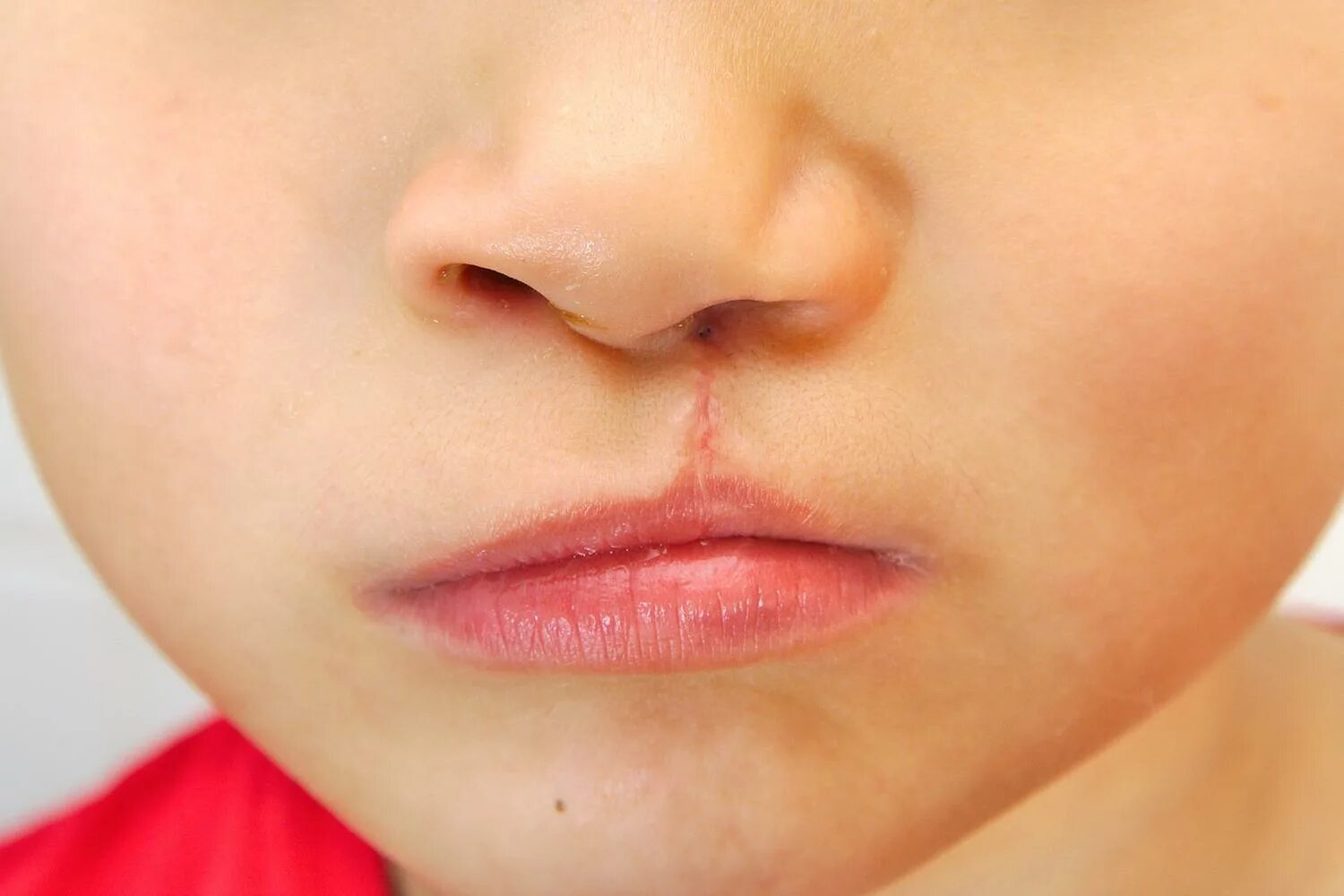 Желтые губы у ребенка. Обожгли ротик от каши ребёнку. Пересыхают губы у ребенка причины фото. Желтая пигментация вокруг рта. Эксфолиативный хейлит.