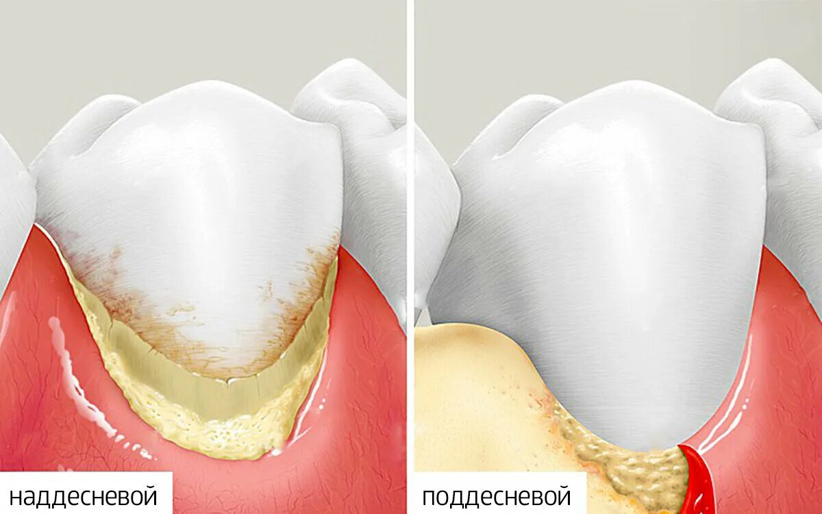 Поддесневой зубной камень. Зубной камень наддесневые отложения. Наддесневой и поддесневой зубной камень. Состав поддесневого зубного камня. Почему сильно зуб