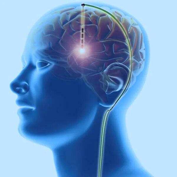 Deep brain. Нейромодуляция головного мозга. Глубинная стимуляция мозга. Система глубокой стимуляции головного мозга. Паркинсон нейростимуляция.