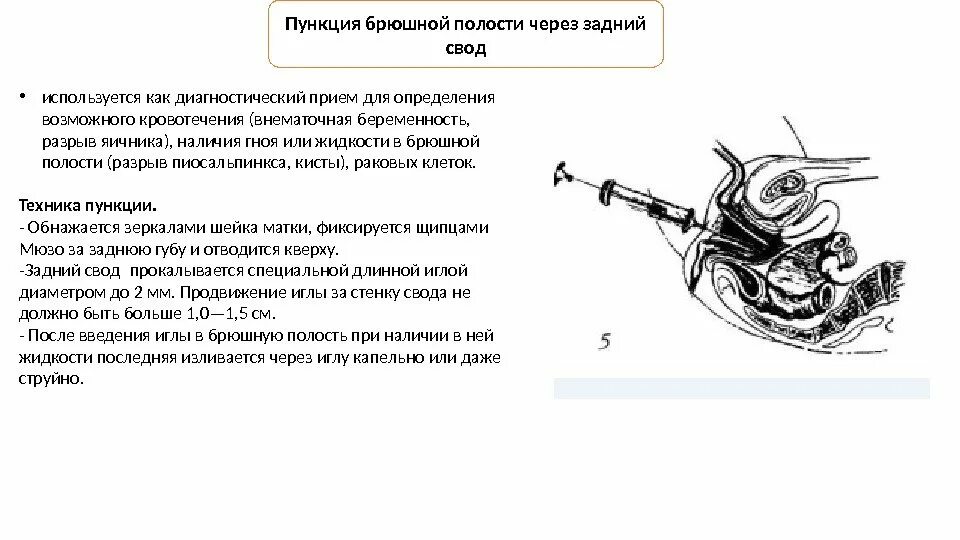 Показания методика выполнения пункции брюшной полости. Пункция заднего свода брюшной полости. Инструмент для проведения абдоминальной пункции. Набор инструментов для пункции брюшной полости алгоритм.