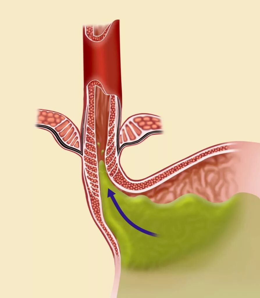 Заброс кислоты из желудка в пищевод симптомы