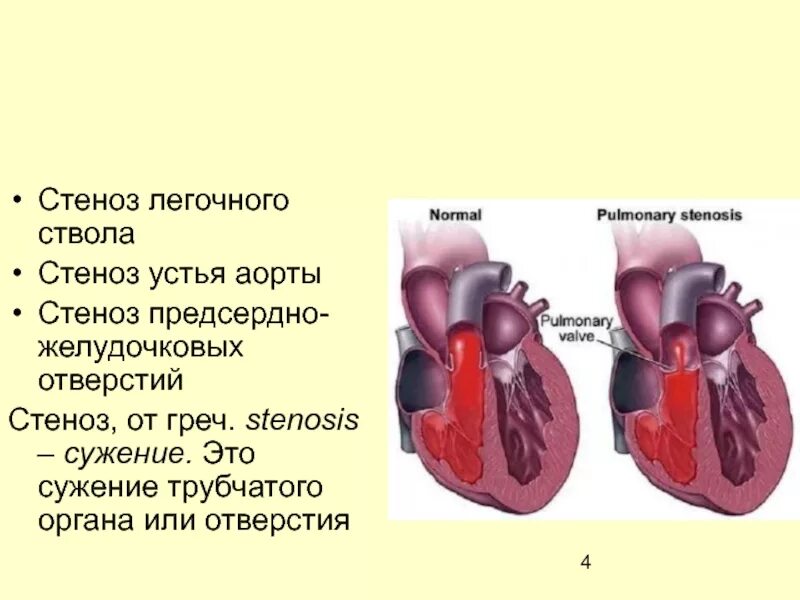 Стеноз легочного ствола