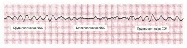 Фж юлчкжсл цхшлтптпшг шхчхс юлщвчл илшлтвь юпнж. Крупноволновая фибрилляция желудочков на ЭКГ. Мелковолновая фибрилляция желудочков ЭКГ. На ЭКГ мелковолновая фибрилляция. Мелковолновая фибрилляция СЛР.