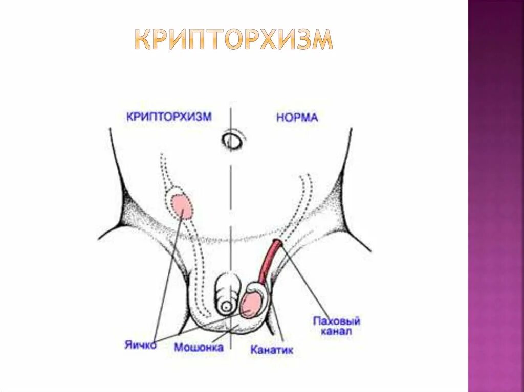 Крипторхизм лечение. Односторонний крипторхизм. Абдоминальный крипторхизм.