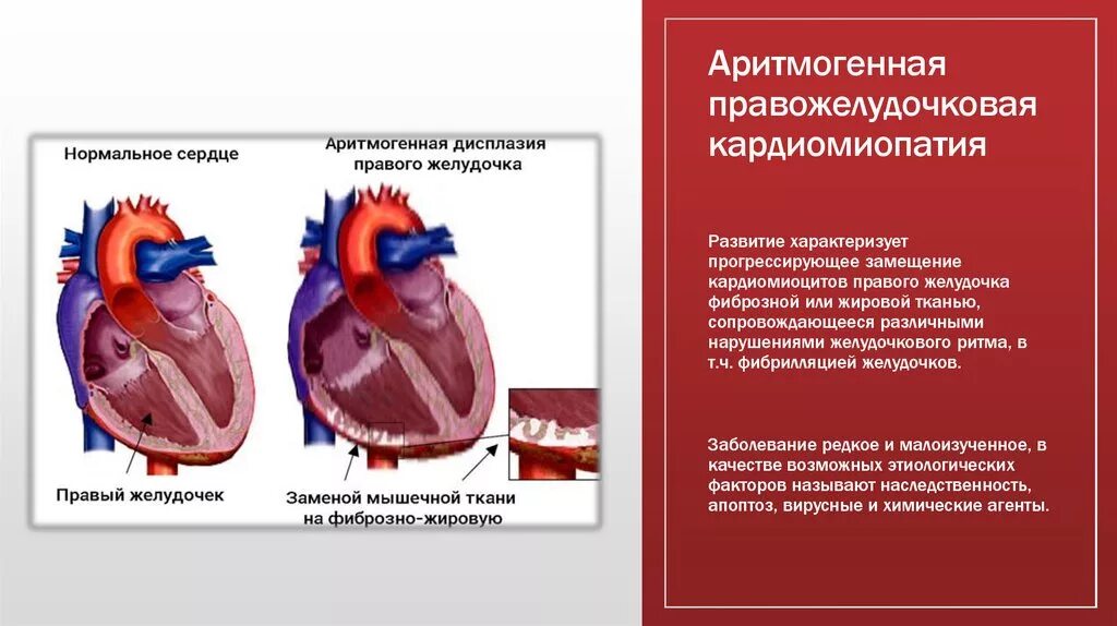 Аритмогенная правожелудочковая дисплазия/кардиомиопатия. Аритмогенная кардиомиопатия симптомы. Аритмогенная КМП. Аритмогенная правожелудочковая кардиомиопатия симптомы.