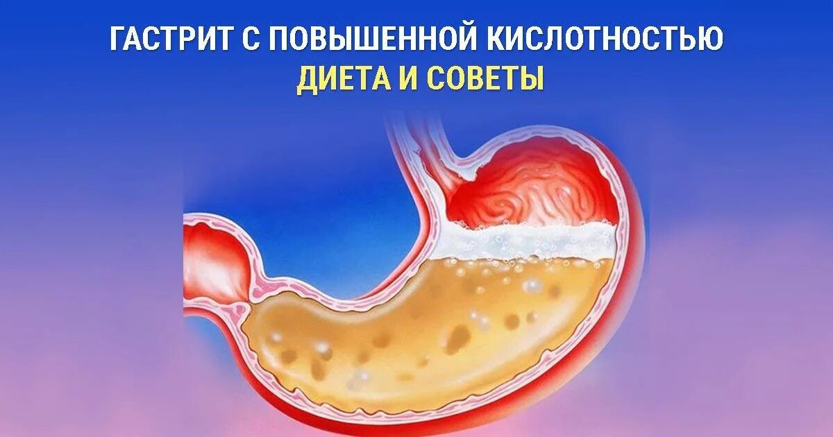 Признаки повышенной кислотности желудка. Гастрит с повышенной кислотностью. Хронический гастрит с повышенной кислотностью. Гастрит повышенная кислотность.