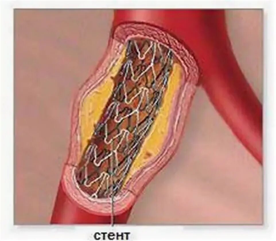 Болит стент. Атеросклероз стентирование. Коронарное стентирование. Стентирование коронарных артерий. Коронарное стентирование сосудов сердца.