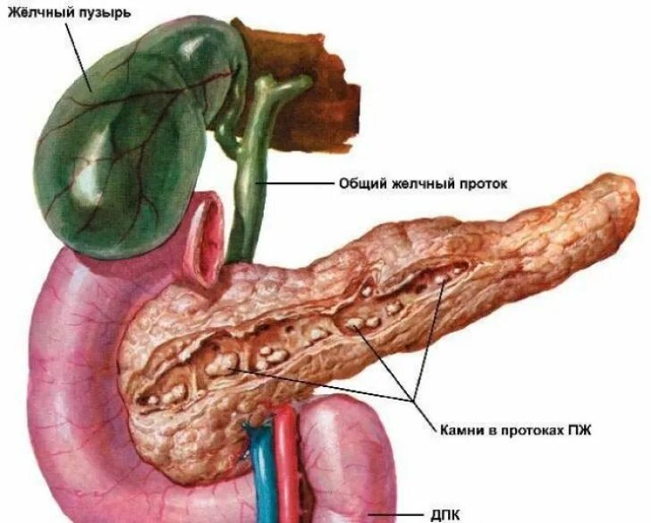 Хронический панкреатит поджелудочная железа. Хронический калькулезный панкреатит. Панкреатит камни в поджелудочной.