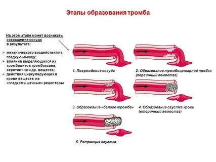 Тромб егэ