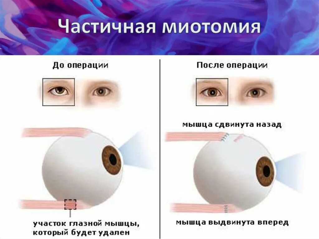 Косоглазие. Операция по коррекции косоглазия у детей. Операция на глаза от косоглазия. Исправление косоглазия у взрослых операция