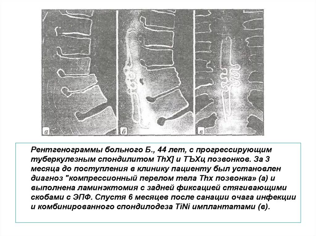 Последствие перелома позвоночника мкб. Компрессионный перелом позвоночника th11-l1. Компрессионный перелом позвоночника рентген. Перелом 12 грудного позвонка рентген. Спондилит поясничного отдела рентген.