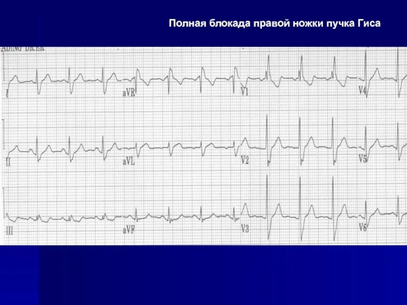 Гиса блокада пнпг. Блокада ПНПГ на ЭКГ. Полная блокада правой ножки пучка Гиса. Полная блокада ПНПГ на ЭКГ. Блокада левой ножки пучка Гиса ПГ.