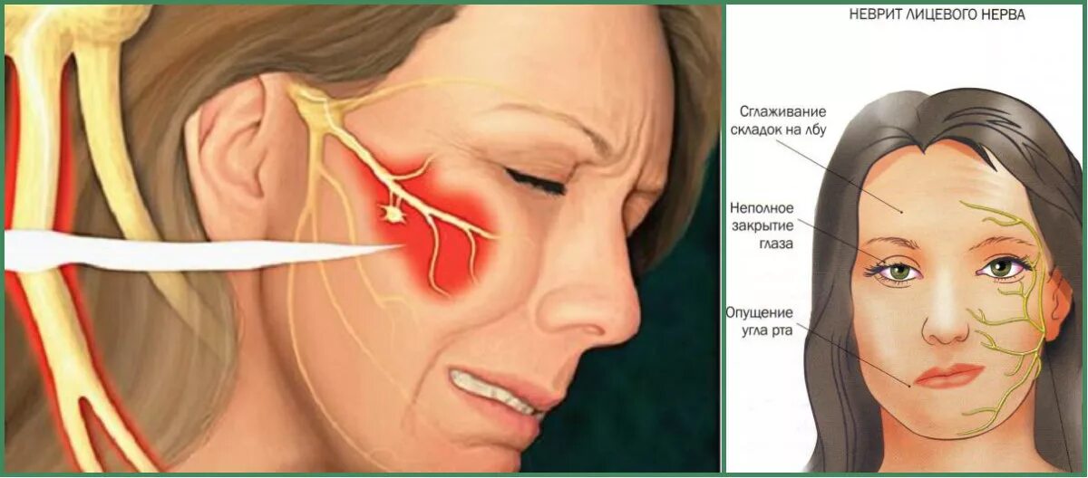 Сводить левую сторону. Воспаление тройничного лицевого нерва симптомы. Прозопалгия левосторонняя прозопалгия. Лицевой нерв и тройничный нервы это. Неврит тройничного нерва симптомы.