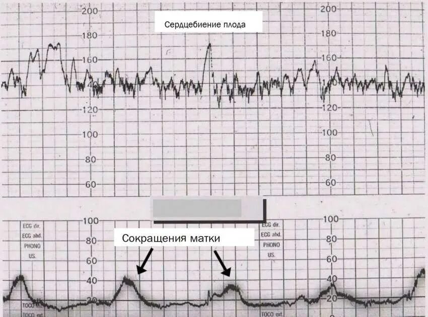 Сердцебиение плода девочка. Как выглядят схватки на КТГ В 40. КТГ при схватках расшифровка. КТГ при беременности схватке. КТГ при беременности 2 схватки.