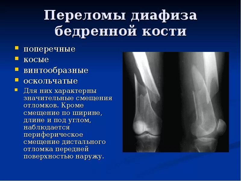 Поперечное смещение