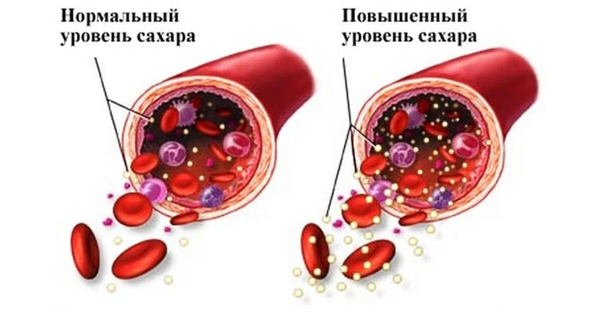 инсулин в крови.