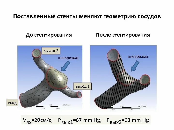 Стенты меняют