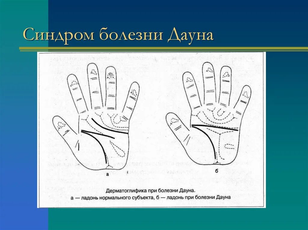 Как узнать синдром дауна. Ладонь ребенка с синдромом дауна. поперечная складка на ладони у дауна. ладонь человека с синдромом дауна.