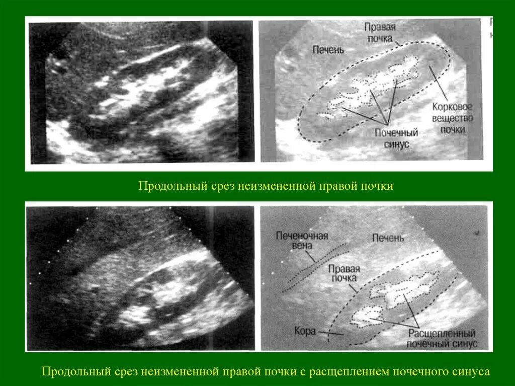 Изменение синусов обеих почек. Продольный срез почки на УЗИ. Нижний полюс почки в продольной плоскости на УЗИ. Продольный срез печени УЗИ. Почечный синус на УЗИ.