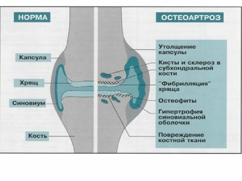 Очаговый остеосклероз большеберцовой кости. Остеосклероз кости рентген. Остеосклероз коленного сустава. Субхондральной костной ткани. Субхондральный склероз локтевой кости.