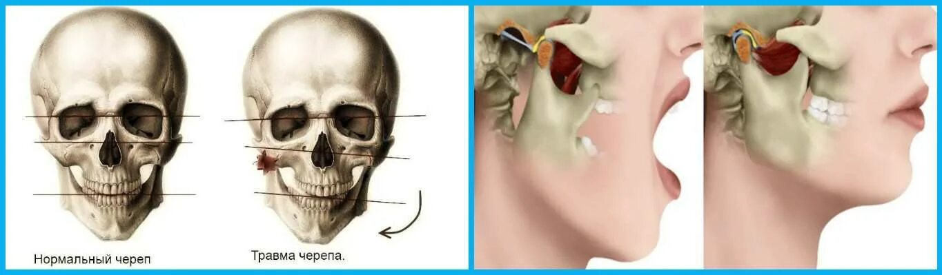 Из за чего может болеть челюсть. Нижняя челюсть скуловая кость. Вывих височно-нижнечелюстного сустава симптомы.