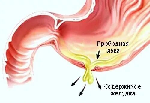 Прободная язва 12 перстной кишки. Прободная язва желудка симптомы. Прободная язва картинки.