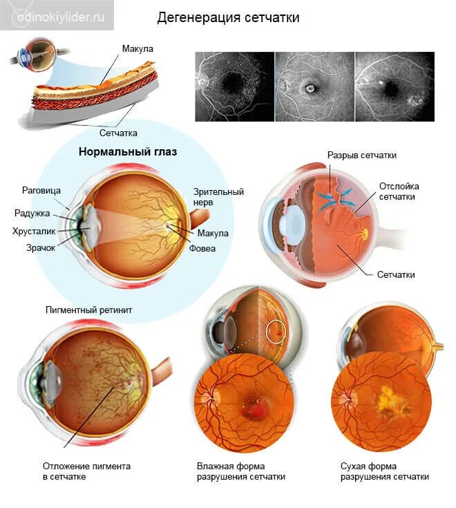 Лечение дегенерации макулы. Пигментная дистрофия сетчатки глаза. Макула дистрофия сетчатки глаза. Пигментная абиотрофия сетчатки. Пигментная дегенерация сетчатки.