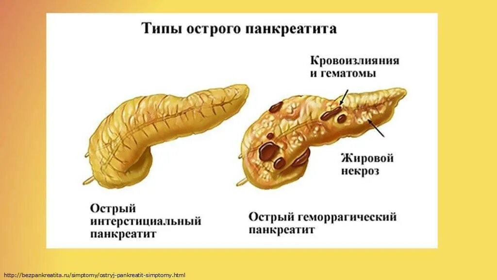 Острый панкреатит поджелудочной железы. Поджелудочная хронический панкреатит. Поджелудочная железа острый и хронический панкреатит. Что такое панкреатит поджелудочной.