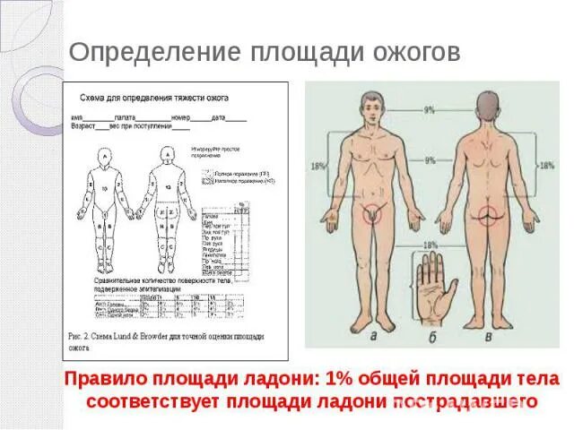 Площадь поражения при ожогах. Площадь ожога степень тяжести. Определение площади ожога. Ожоги площадь поражения.