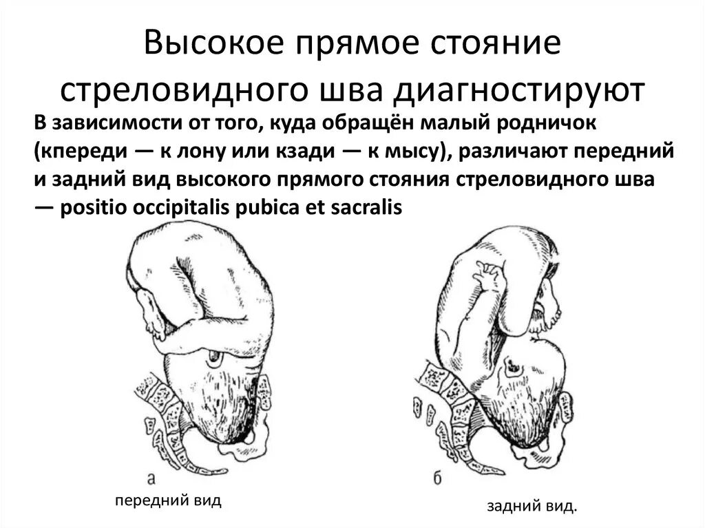 Положения головки плода. Высокое прямое и низкое поперечное стояние стреловидного шва. Прямое стояние стреловидного шва. Высокое поперечное стояние стреловидного шва. Высокое прямое стояние стреловидного шва.