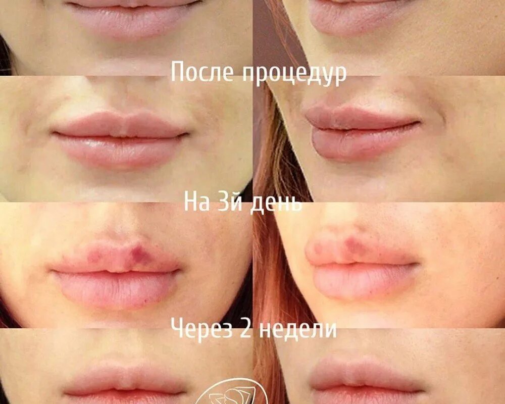 Губы после увеличения по дням. Губы с 1 мл гиалуроновой кислоты до после до после зажившие. увеличение губ зажившие. зажившие губы после увеличения. этапы заживления губ после увеличения.