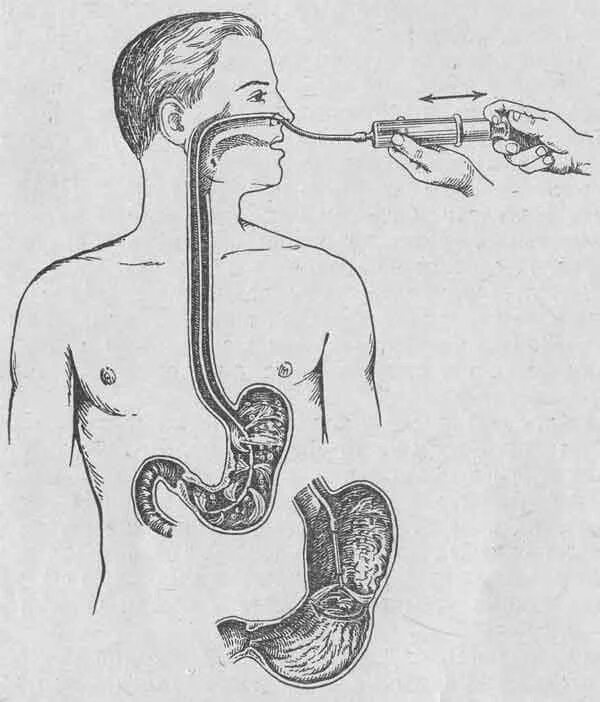 Проглотить мокроту во время поста. Желудочный зонд назогастральный. Назогастральный зонд промывание желудка. Дуоденальное зондирование трубка. Назогастральный зонд Введение.