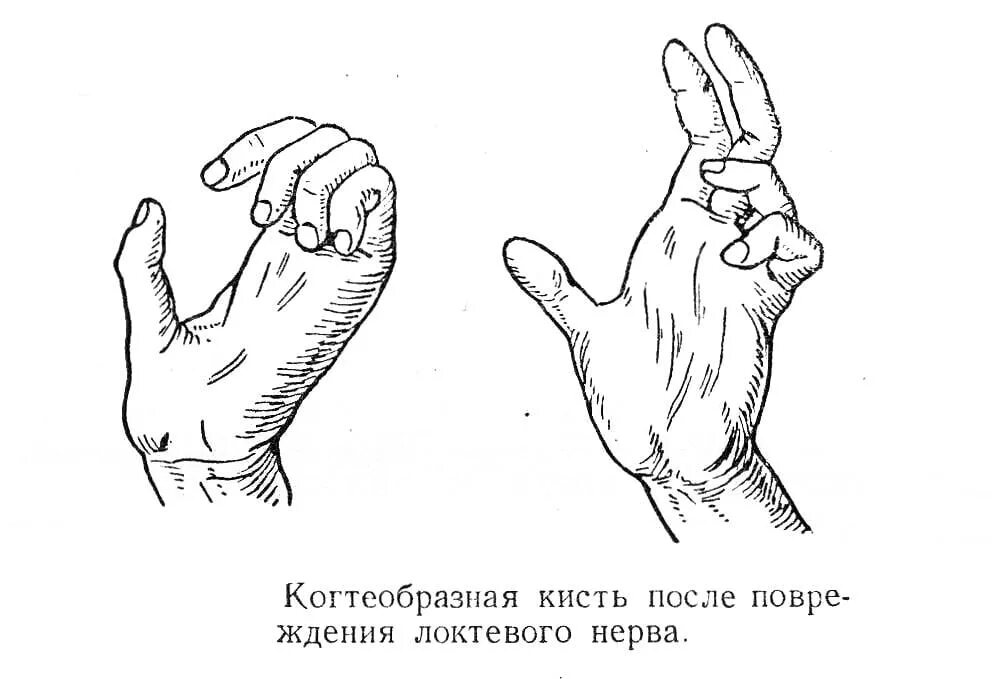 Повреждение локтевого нерва кисти. Синдром поражения локтевого нерва. Обезьянья лапа симптом поражения нерва. Признаки повреждения локтевого нерва.