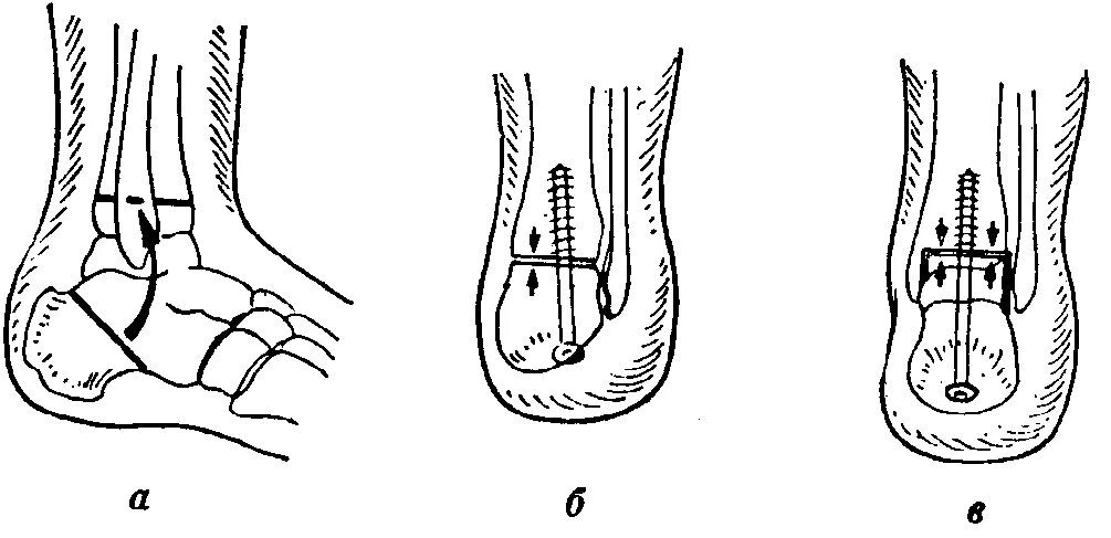 Костно пластическая ампутация голени по пирогову. Пирогов костно-пластическая ампутация голени. Костно пластическая ампутация голени по пирогову. Костнопластическая ампутация голени по н. И.