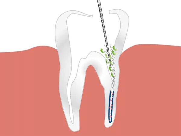 Расширение каналов зубов. Ультразвуковая ирригация корневых. Ирригация корневых каналов в эндодонтии. Активная ирригация корневых каналов.