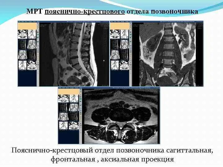 Мрт 1.5 пояснично-крестцового отдела позвоночника. Мрт расшифровка снимков поясничного отдела. Снимок мрт пояснично крестцового отдела позвоночника. Мрт крестцового отдела норма.