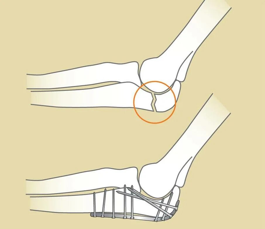 Трещина кости лечение. Остеосинтез локтевого отростка. Перелом локтевого отрос. Перелом локтевого отростка локтевого сустава. Внутрисуставной перелом локтевого отростка.
