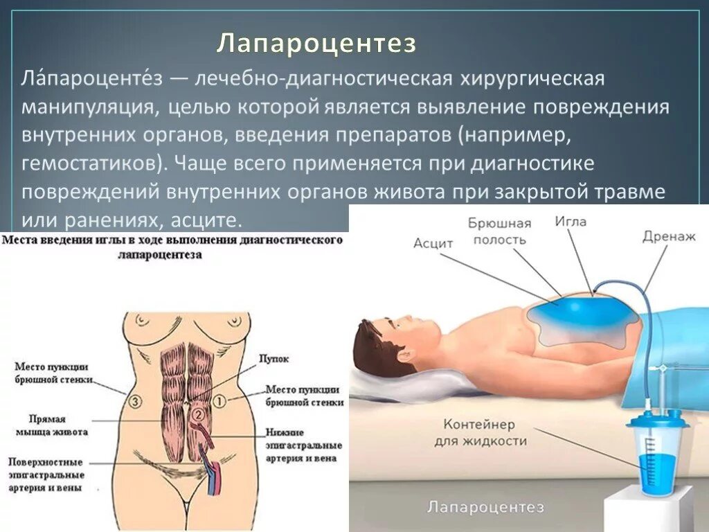 Абдоминальная пункция (лапароцентез). Лапароцентез хирургия пункция. Асцит лапароцентез методика. Лапароцентез техника место прокола. Осложнения после пункции