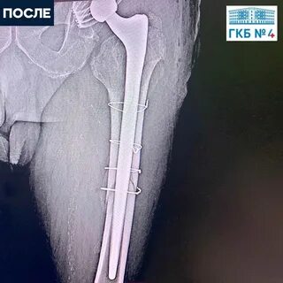 Перелом бедренной кости со смещением