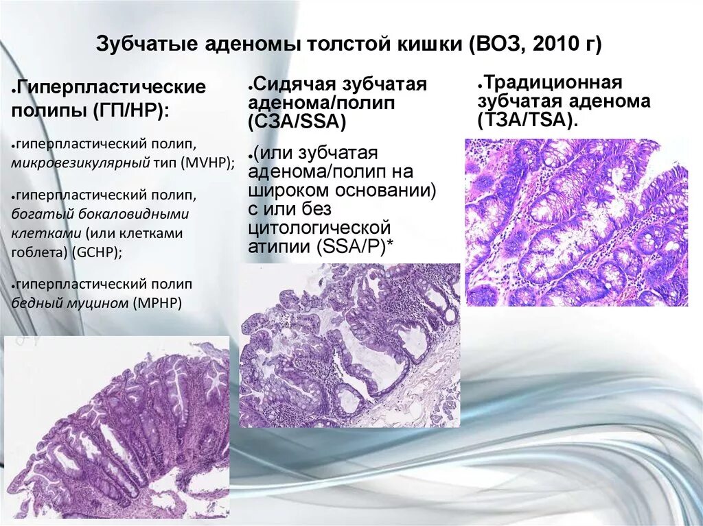 Тубулярная аденома толстой. Зубчатая аденома кишки гистология. Гиперпластический полип толстой кишки гистология. Зубчатая аденома толстой кишки гистология. Микровезикулярный полип толстой кишки гистология.