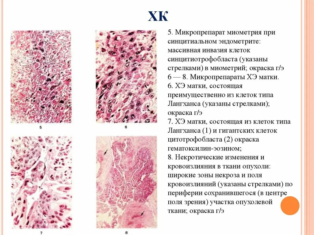 Эндометрит гистология. Хориоэпителиома маткимикропрепарат. хорионэпителиома матки микропрепарат. трофобластическая болезнь микропрепарат. трофобластическая болезнь гистология.