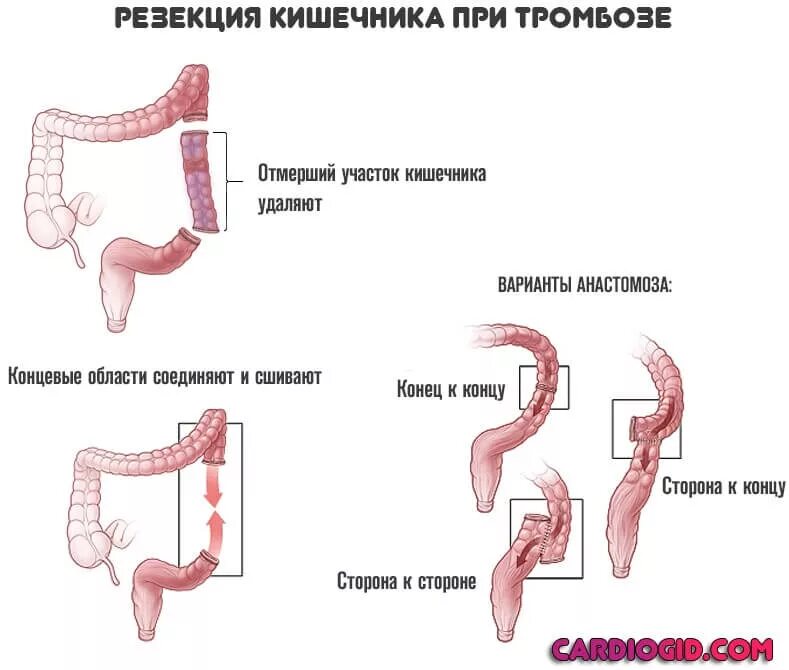 Операция резекции Толстого кишечника. Резекция толстой кишки этапы. Операция по резекции части толстой кишки. Схема резекции кишечника при некрозе кишки. Стеноз прямой