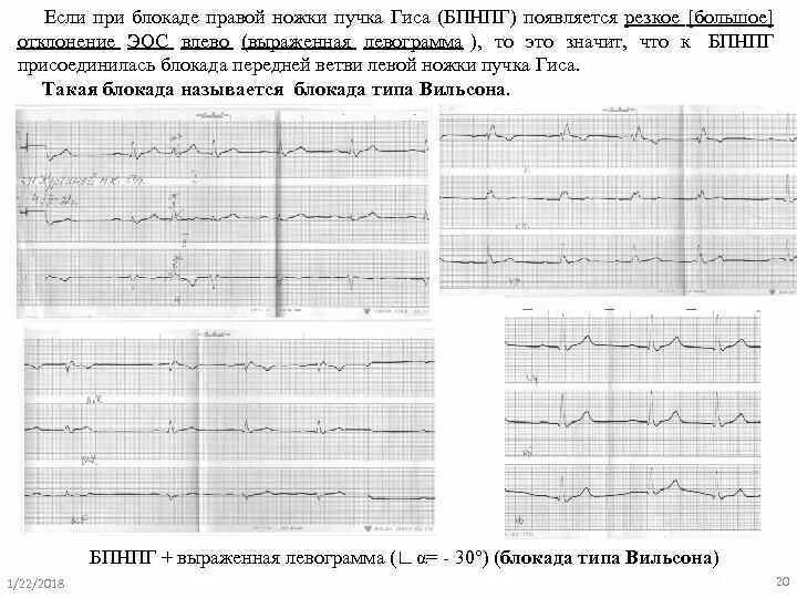 Блокада ПНПГ И передней ветви ЛНПГ на ЭКГ. Неполная блокада передней ветви ЛНПГ на ЭКГ. Блокада ПНПГ на ЭКГ. Блокада передне-верхнего разветвления левой ножки. Блокада левого и правого пучка гиса