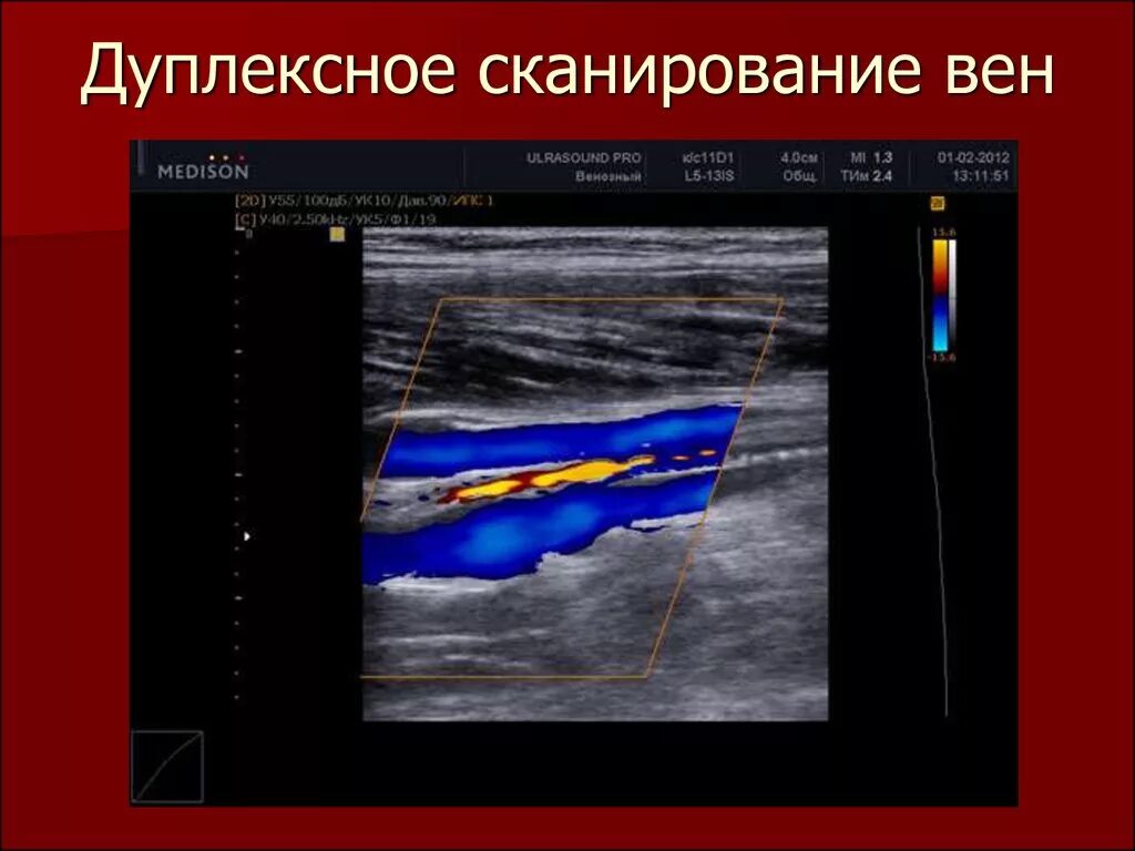 Дуплексное сканирование вен нижних конечностей что это. Ультразвуковая допплерография артерий нижних конечностей. Допплеровское сканирование сосудов нижних конечностей. Ультразвуковое дуплексное ангиосканирование. Ультразвуковое исследование вен нижних конечностей.