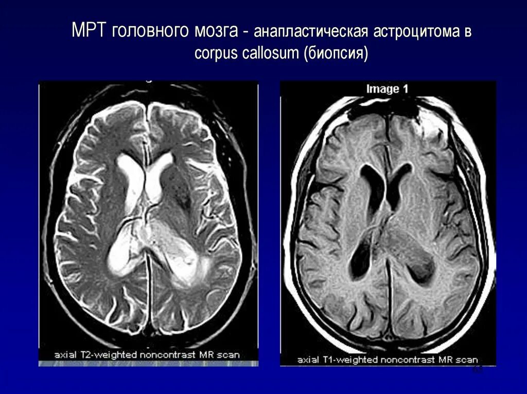 Пилоидная астроцитома. Субэпендимальная гигантоклеточная астроцитома мрт. Мультифокальная анапластическая астроцитома. Анапластическая астроцитома кт. Опухоль головного мозга астроцитома.