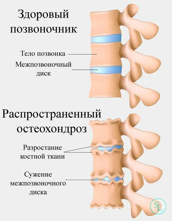 Хандрос сильная боль. Спондилёз поясничного. Деформирующий спондилез. Спондилез позвоночника. Остеохондроз поясничного отдела 2 степени.