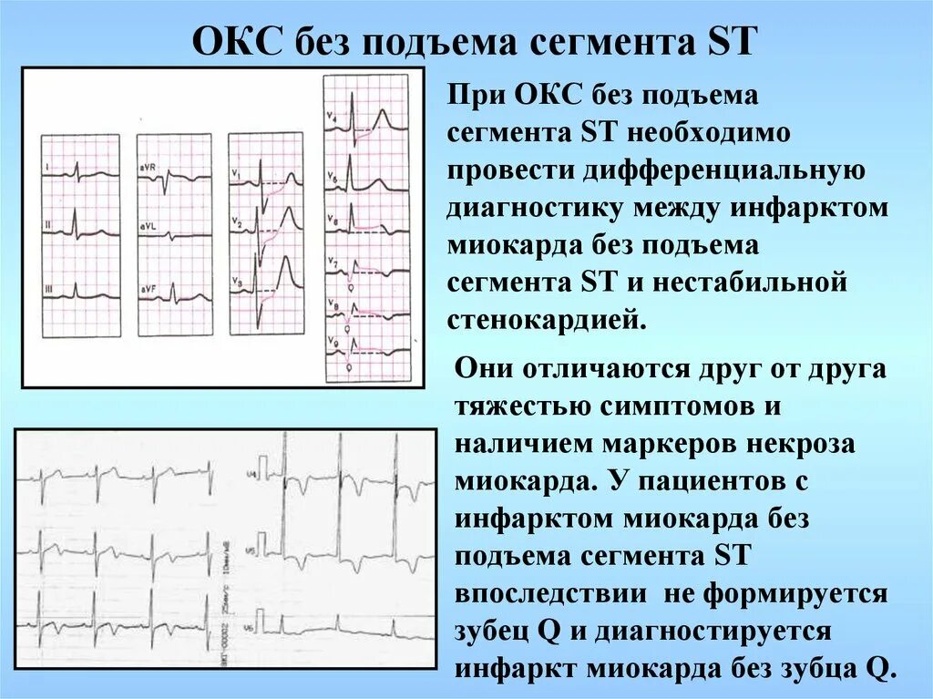 Экг подъем. ЭКГ инфаркт миокарда без подъема St. ЭКГ критерии Окс без подъема St. ЭКГ без подъема сегмента St. ЭКГ инфаркт миокарда с подъемом St.