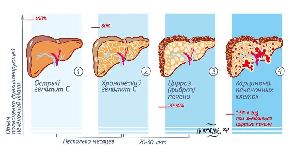 Сколько живете с гепатитом в. Цирроз печени стадии развития. Изменения печени при циррозе.