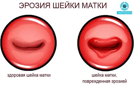 Шейка матки психосоматика