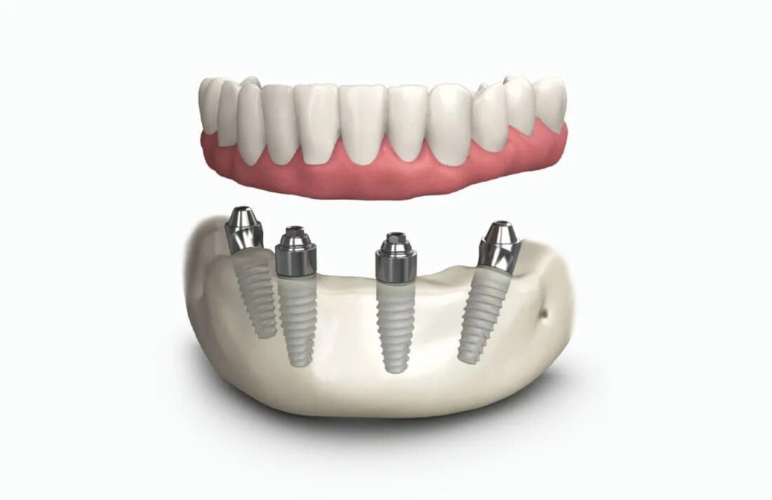 Имплантация зубов all on 4. Технология имплантации зубов all-on-4. Балочный протез на 4 имплантах. Протезирование зубов инвалидам 3 группы